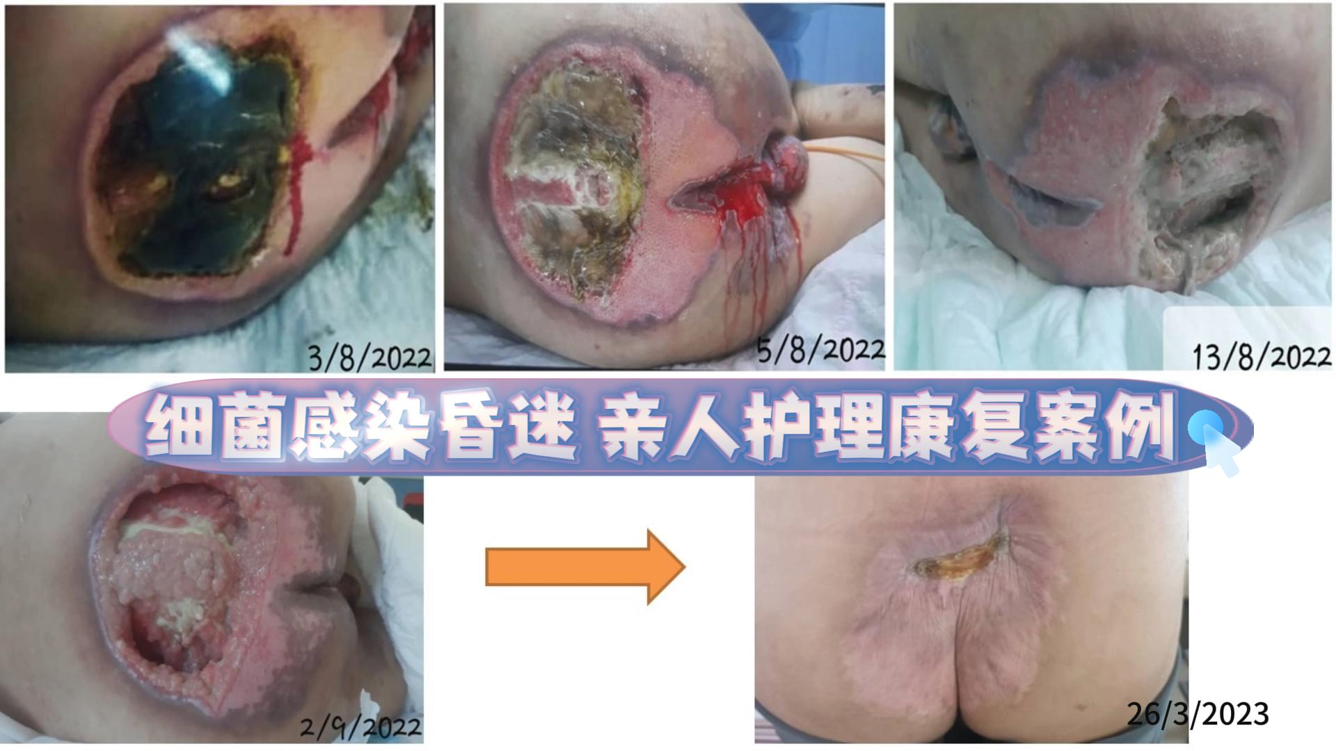 严重细菌感染昏迷、四期褥疮 亲人护理康复案例-刘莲美